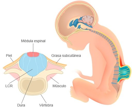 espina-bifida-sintomas