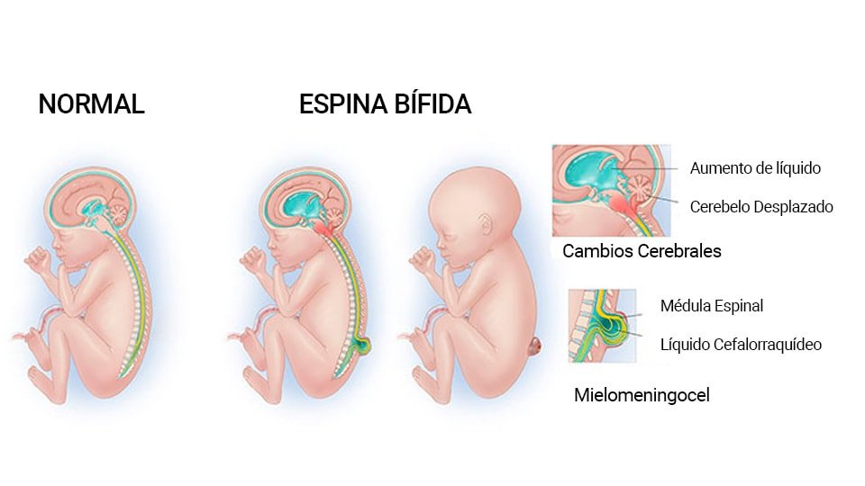 espina-bifida