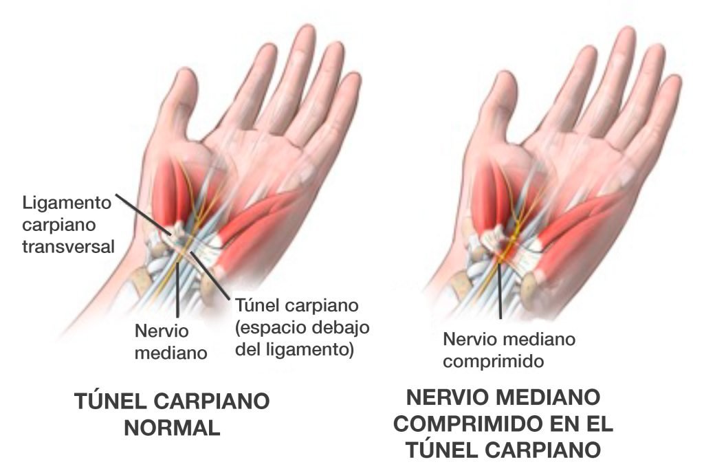 sindrome-del-tunel-carpiano